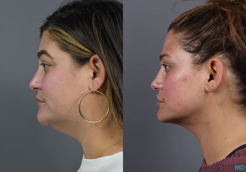 Liposuction of the Neck - Thumbnail 2