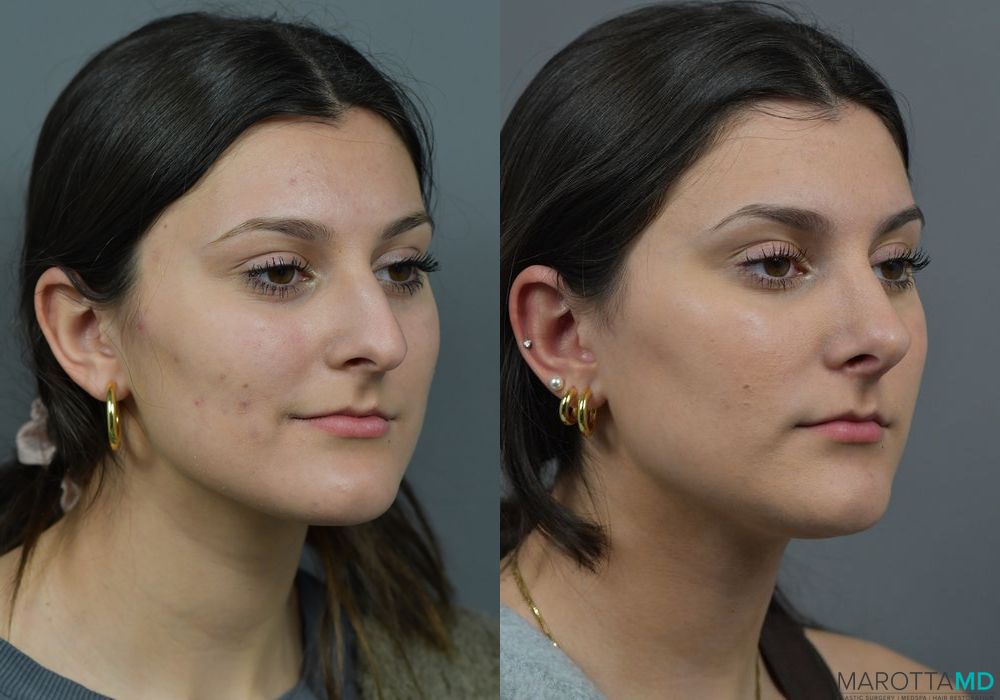 Before and after Rhinoplasty case 7283 - Angle 2
