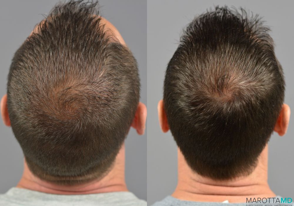 Hair Transplantation - Thumbnail 3