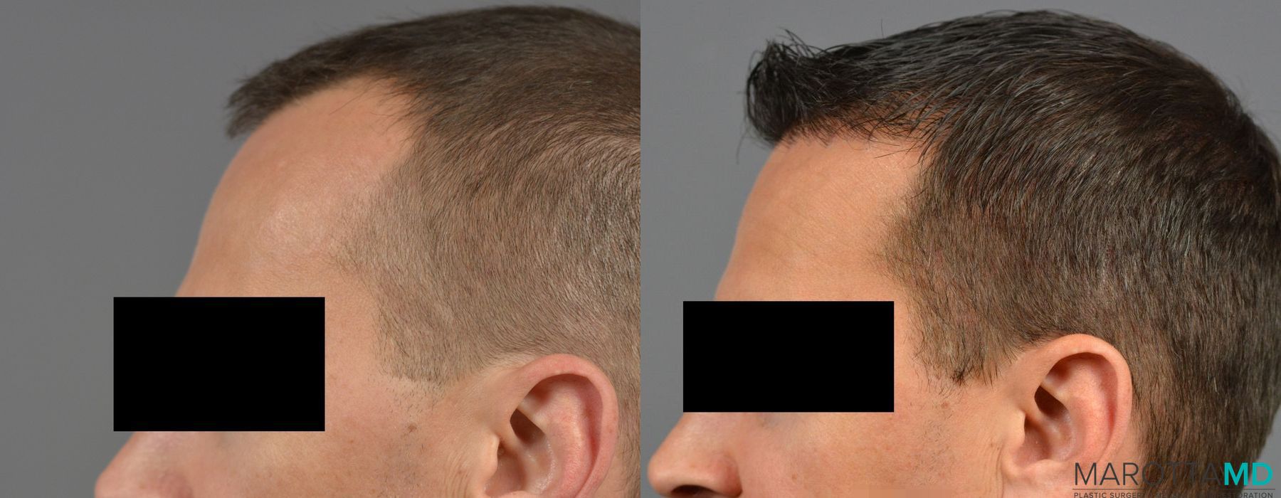 Hair Transplantation - Thumbnail 4