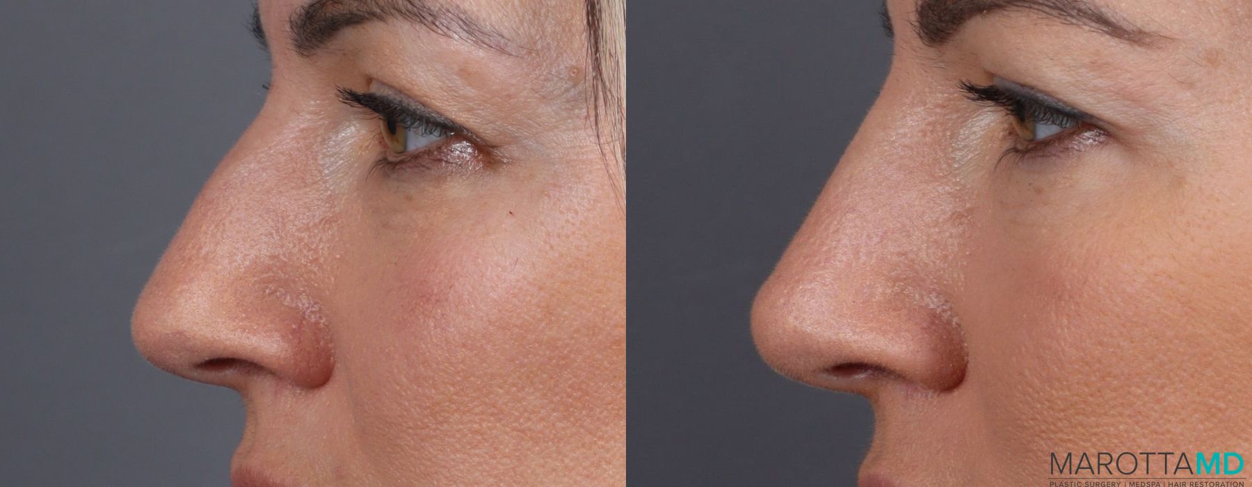 Non-Surgical Rhinoplasty - Case 408