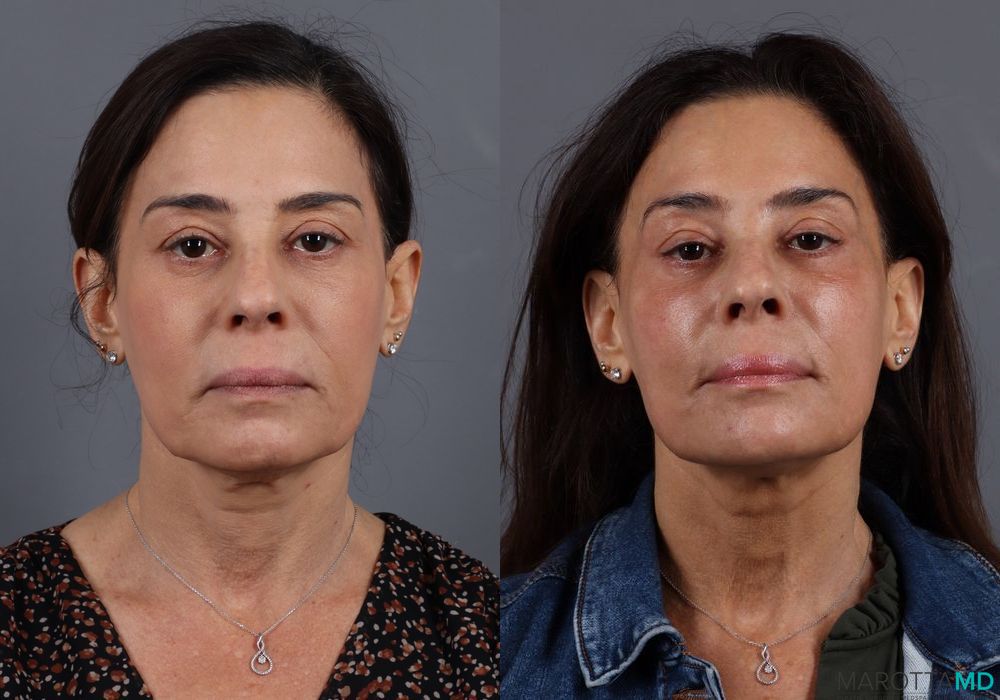Before and after Filler - Chin case 7291