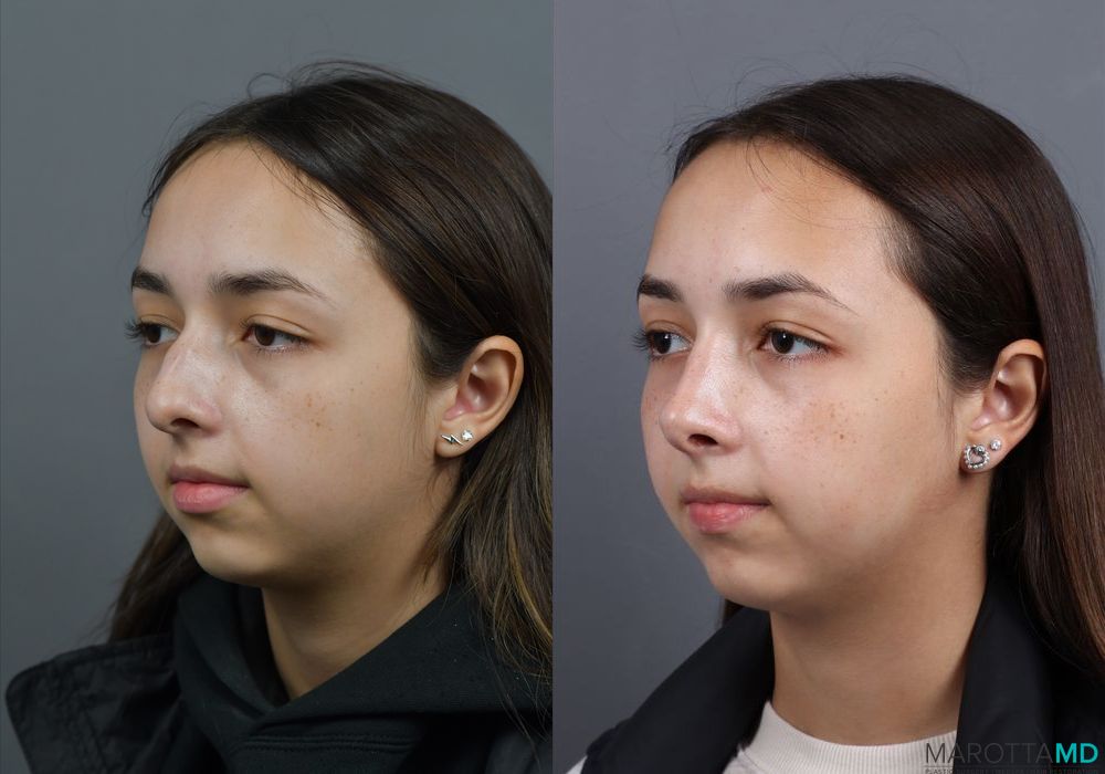 Before and after Rhinoplasty case 7279 - Angle 2