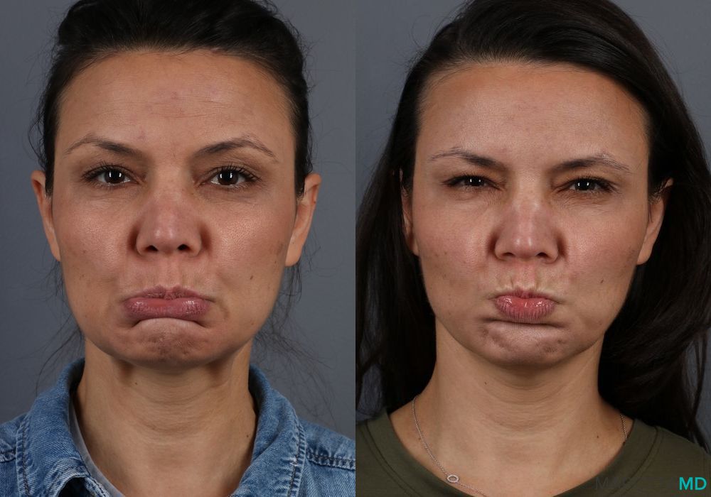 Before and after Botox - Chin case 7163 - Angle 3