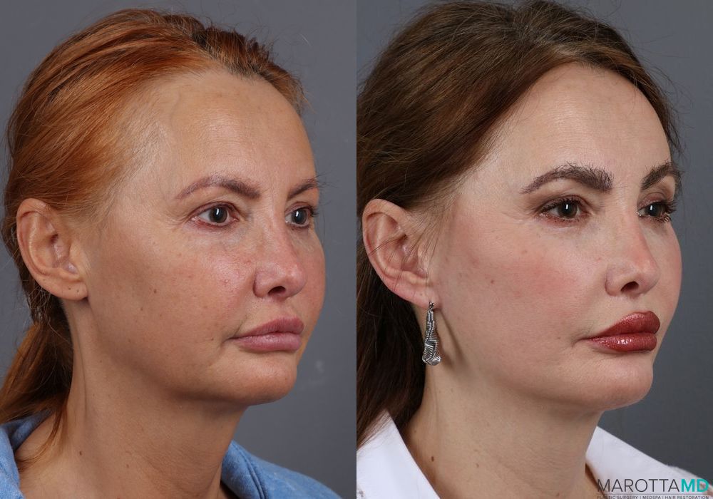 Mini Facelift - Thumbnail 2