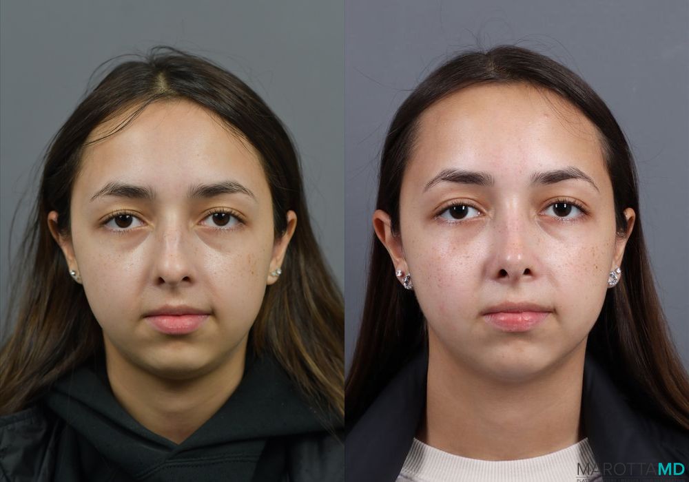 Before and after Rhinoplasty case 7279