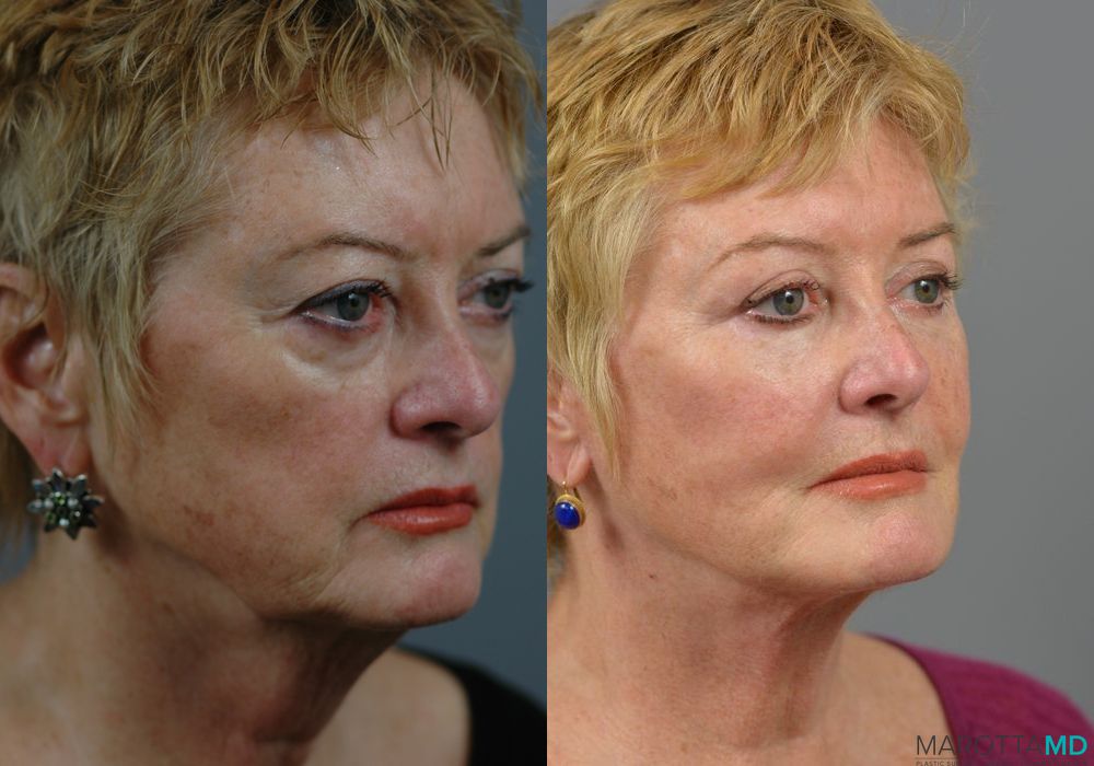 Blepharoplasty - Case 142