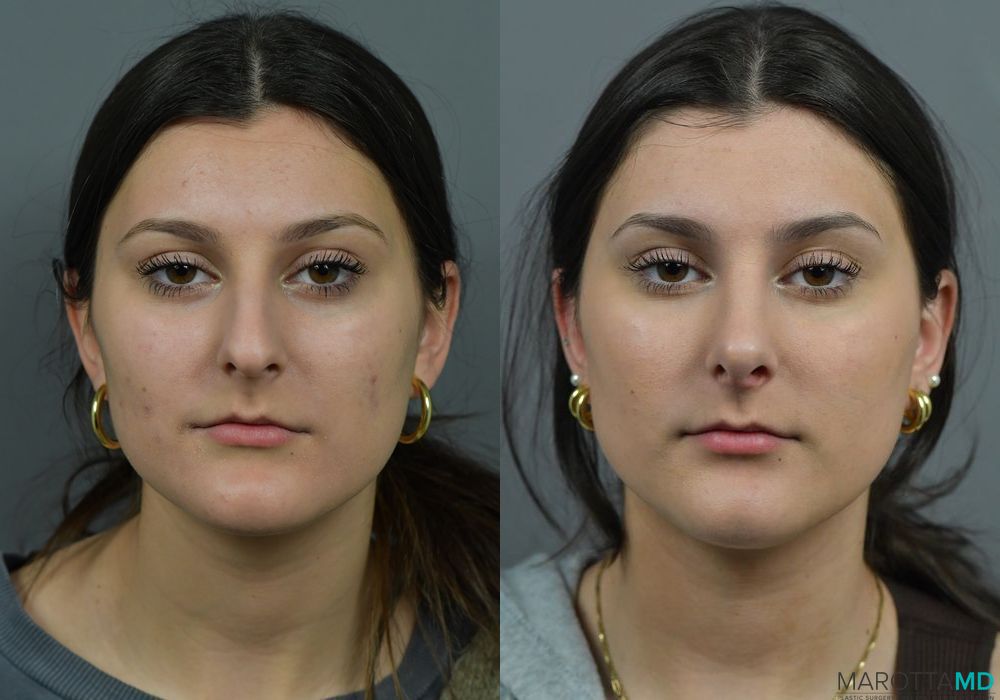 Before and after Rhinoplasty case 7283