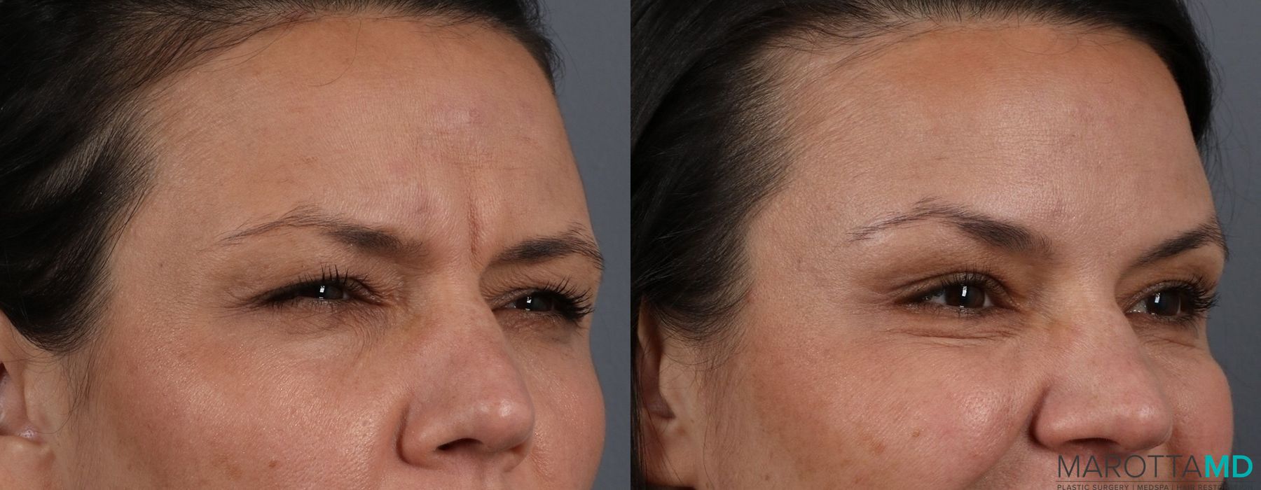 Before and after Botox - Forehead case 7156 - Angle 4
