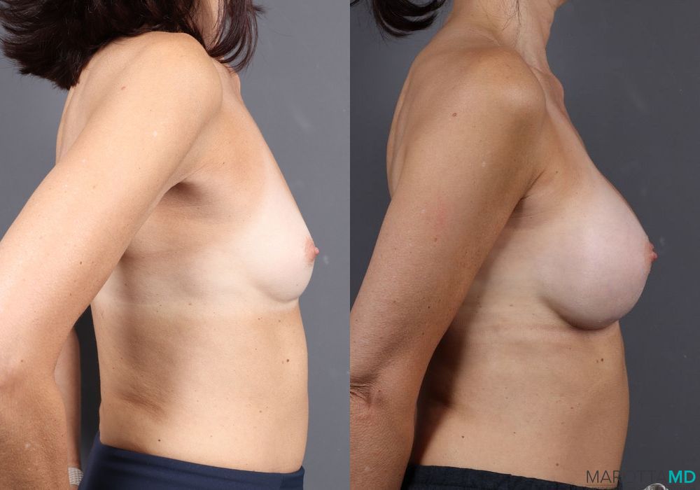 Breast Augmentation - Thumbnail 5