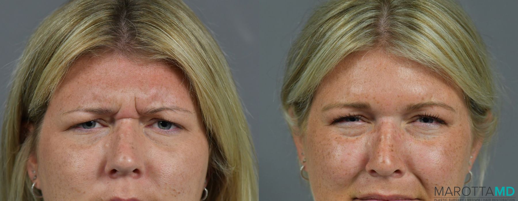 Before and after Botox - Glabella case 7185