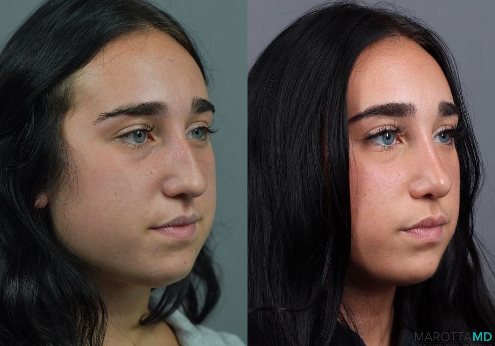 Before and after Rhinoplasty case 7286 - Angle 2