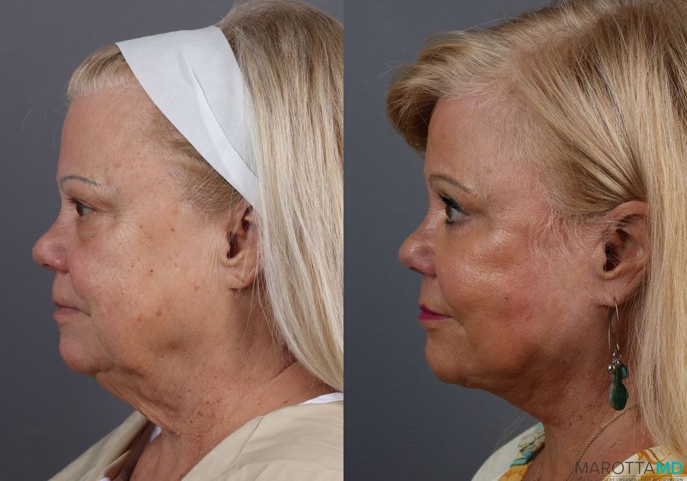 Laser Skin Resurfacing - Face - Thumbnail 4