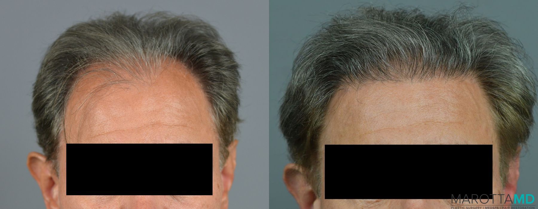 Hair Transplantation - Thumbnail 2