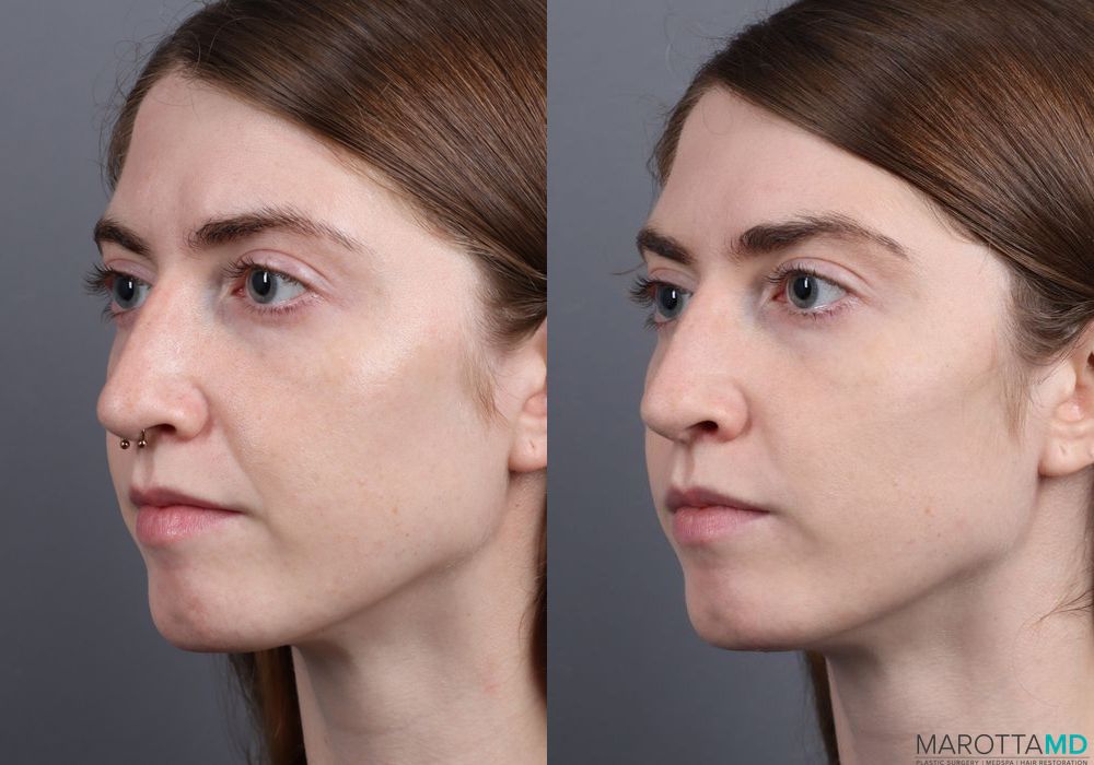 Juvederm / Fillers - Thumbnail 5