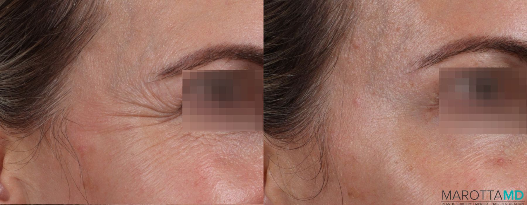 Before and after Botox - Forehead case 7159 - Angle 3