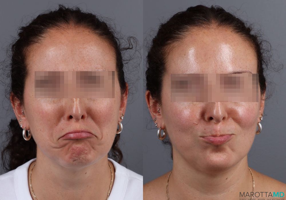 Before and after BOTOX® Cosmetic case 7191 - Angle 4