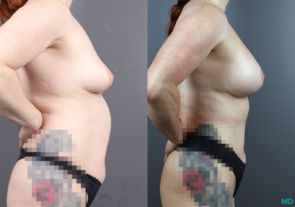 Before and after Breast Augmentation case 7079 - Angle 4
