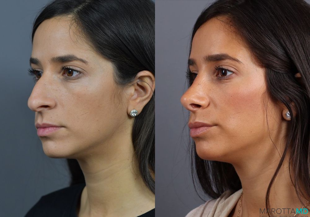 Before and after Rhinoplasty case 7278 - Angle 2