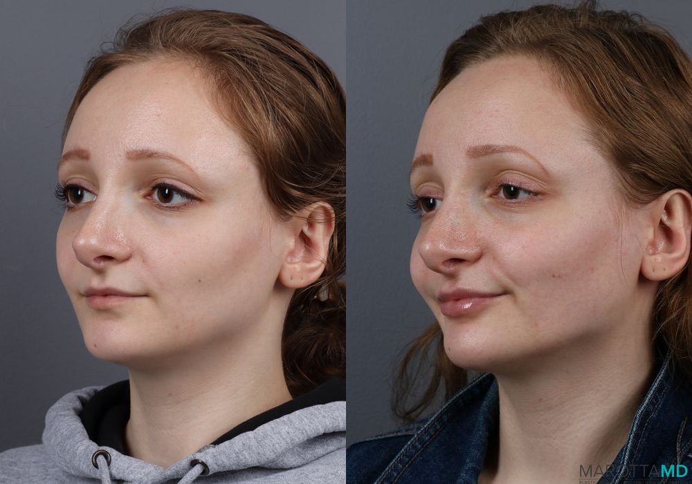Before and after Fillers case 7141 - Angle 4