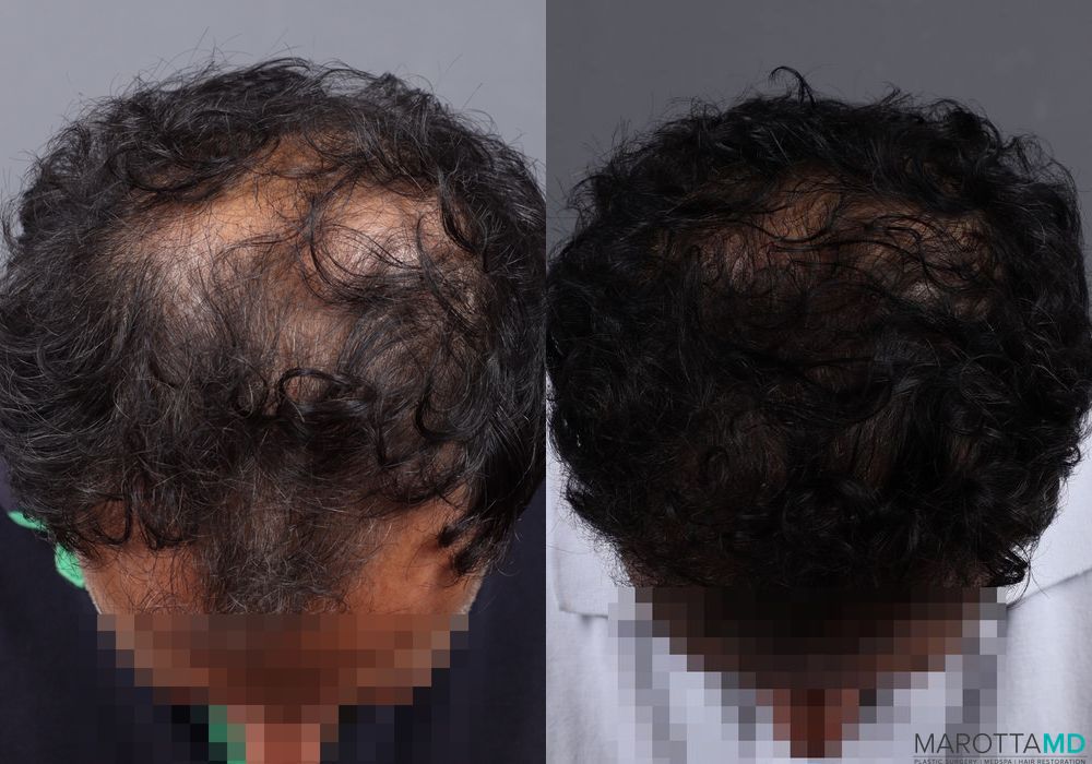 Hair Transplantation - Thumbnail 4