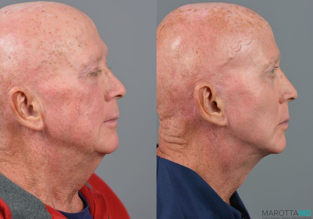 Cheek Augmentation - Thumbnail 4