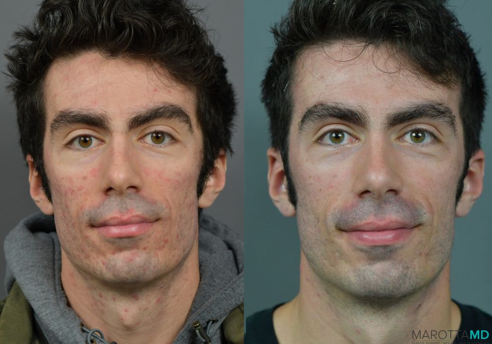 Microneedling - Case 406