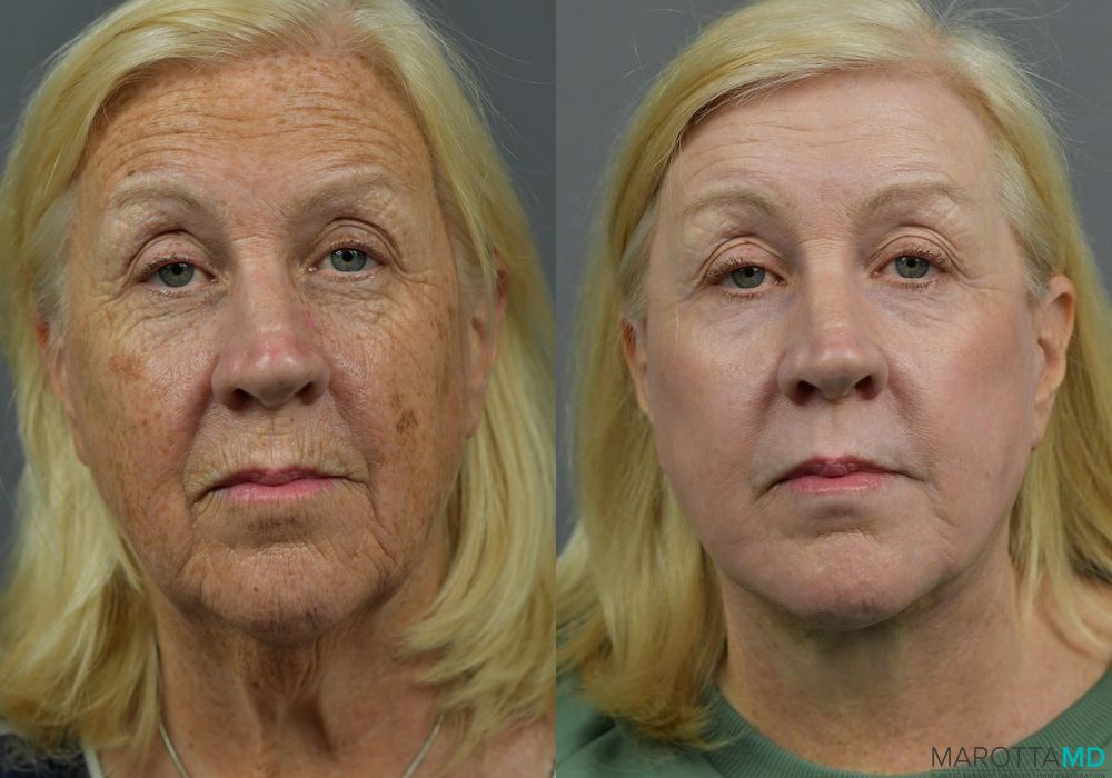 Facelift & Neck Lift - Case 993