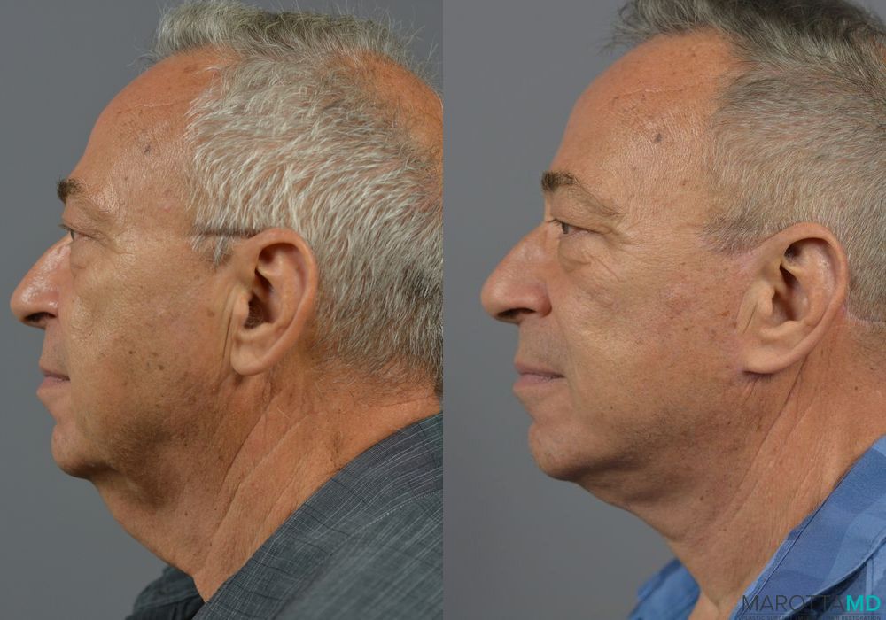 Facelift & Neck Lift - Thumbnail 3