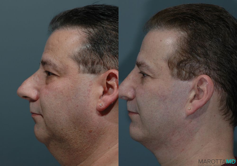 Facelift & Neck Lift - Thumbnail 3
