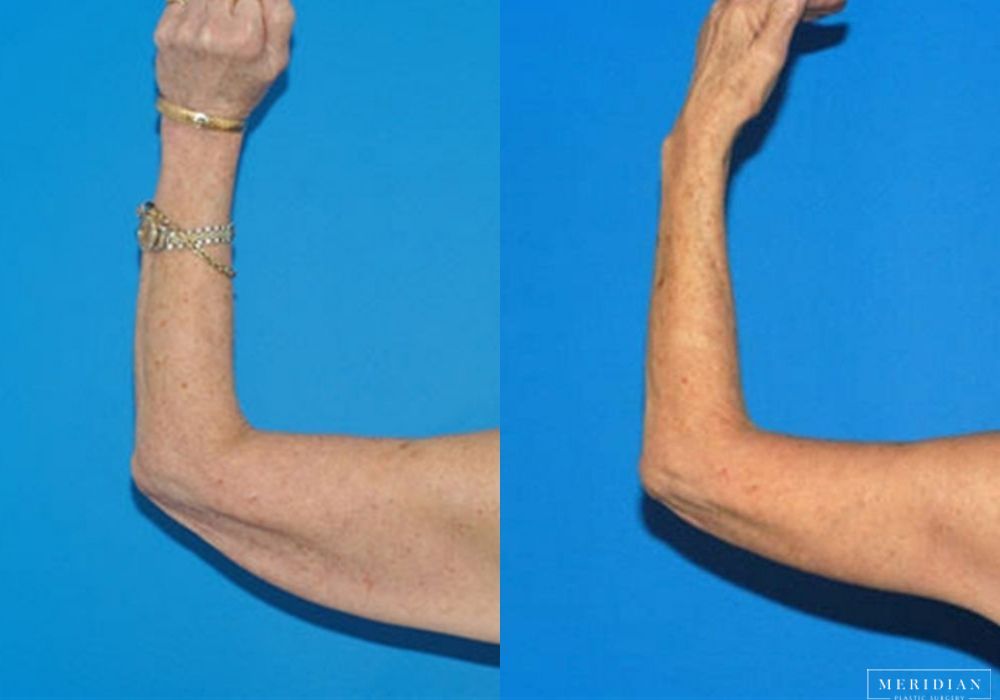 Arm Lift - Case 8137