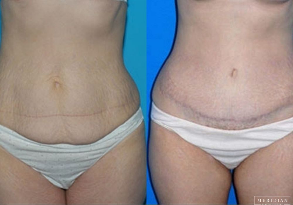 Body Contouring - Case 7967