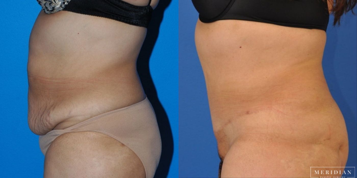 Body Contouring - Thumbnail 2