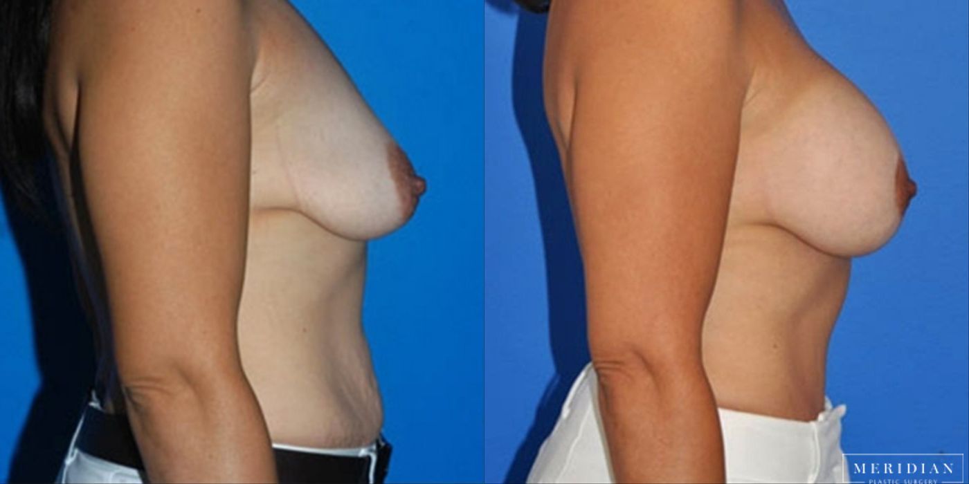 Body Contouring - Thumbnail 2