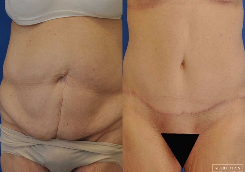 Body Contouring - Case 7972