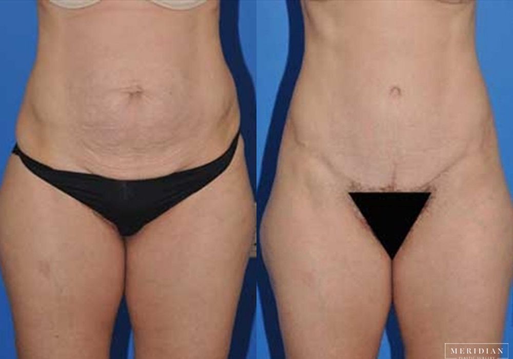 Body Contouring - Case 7963