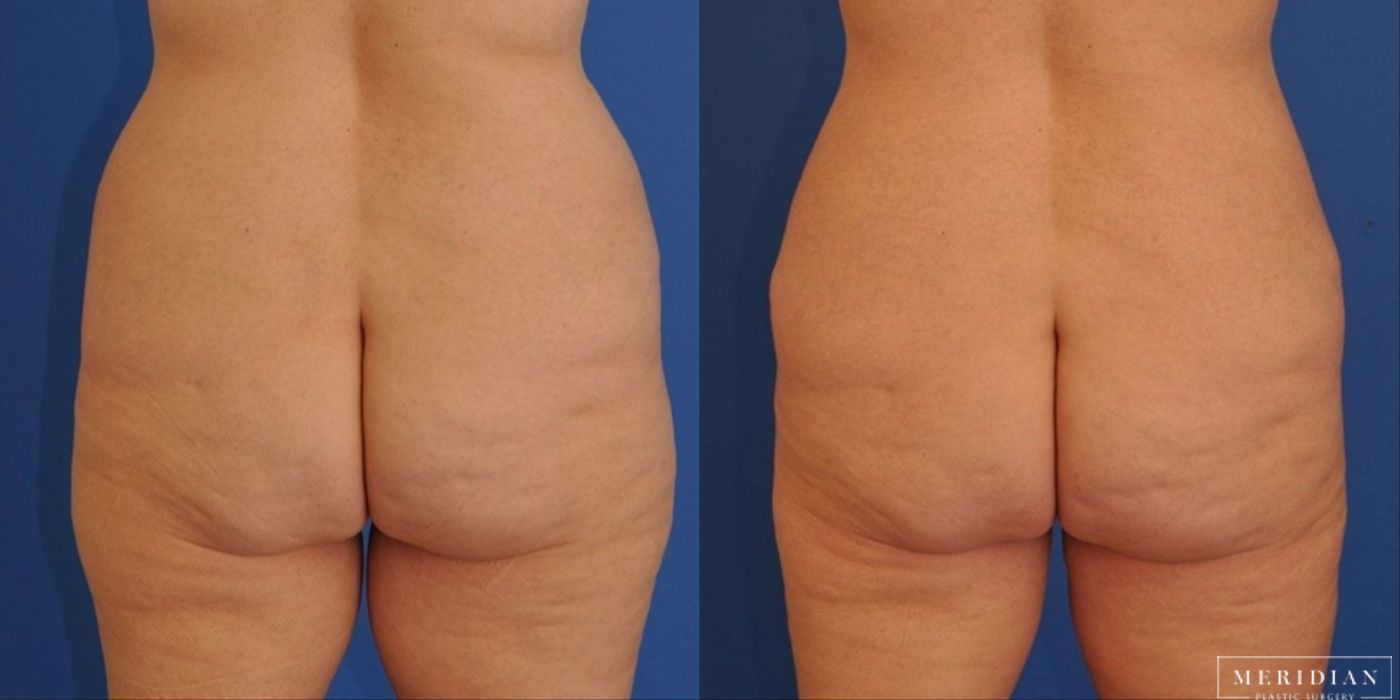 Body Contouring - Thumbnail 2