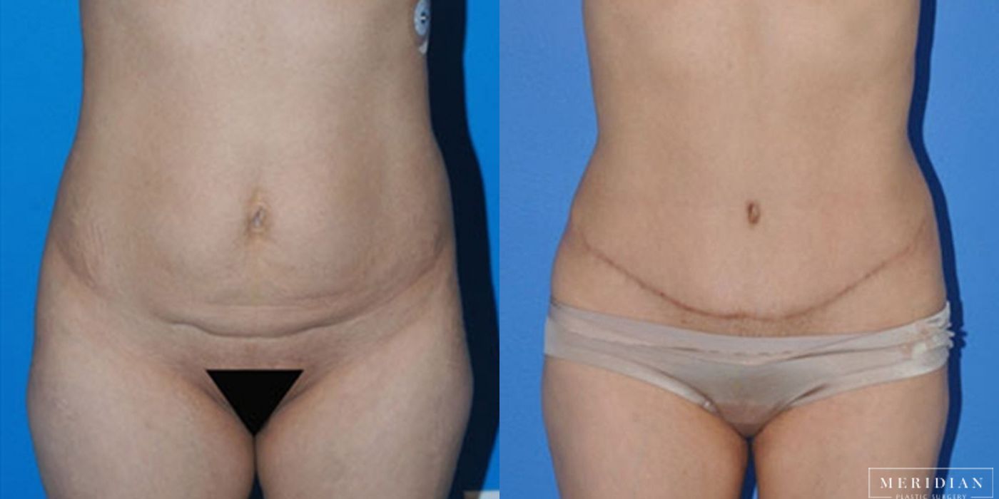 Body Contouring - Thumbnail 2