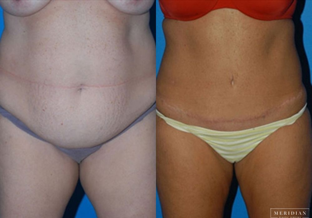 Body Contouring - Case 7964