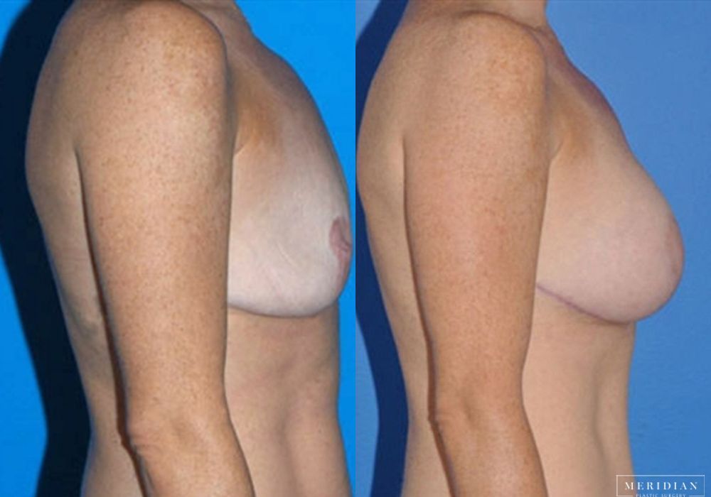 Body Contouring - Thumbnail 2