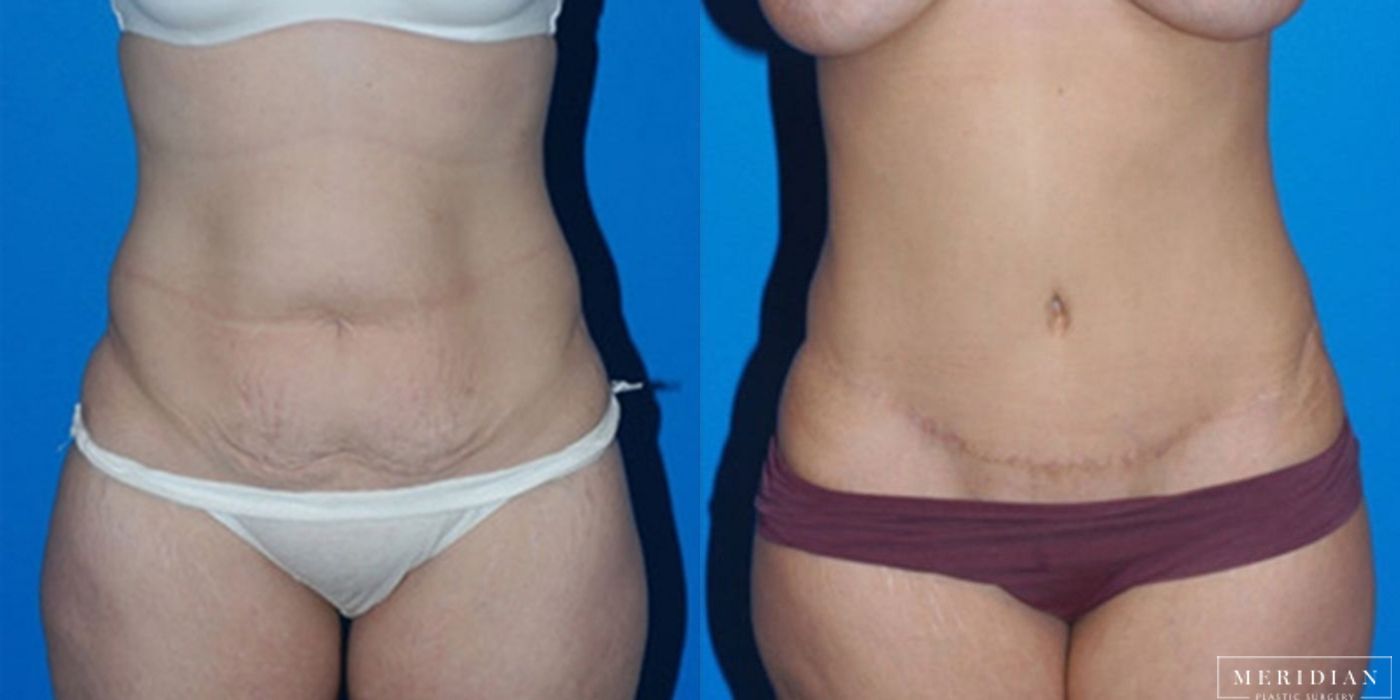 Body Contouring - Case 8451