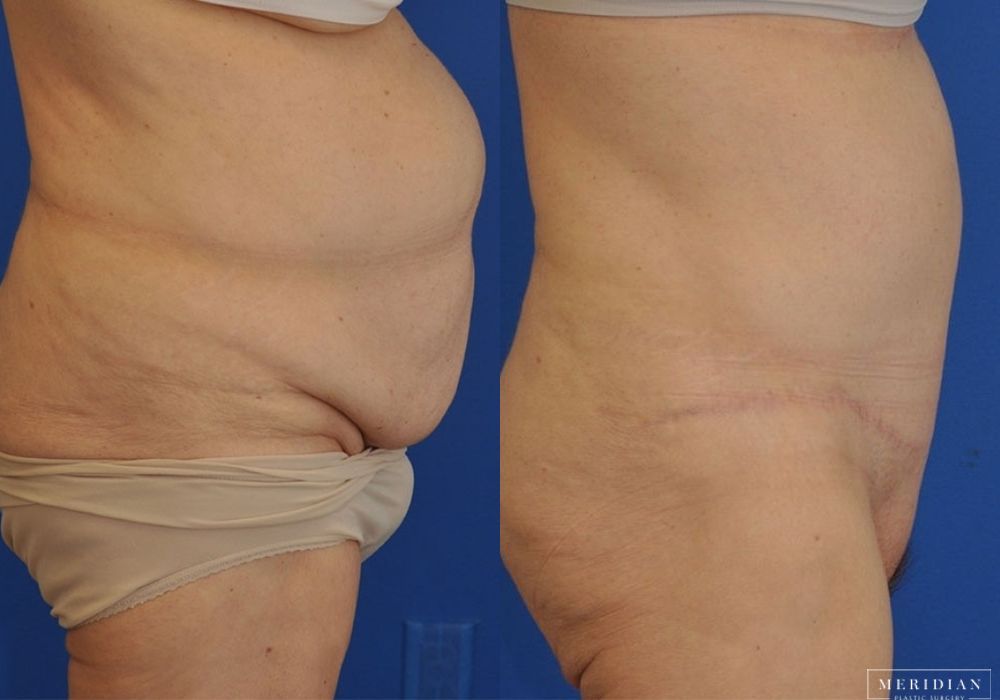 Body Contouring - Thumbnail 2