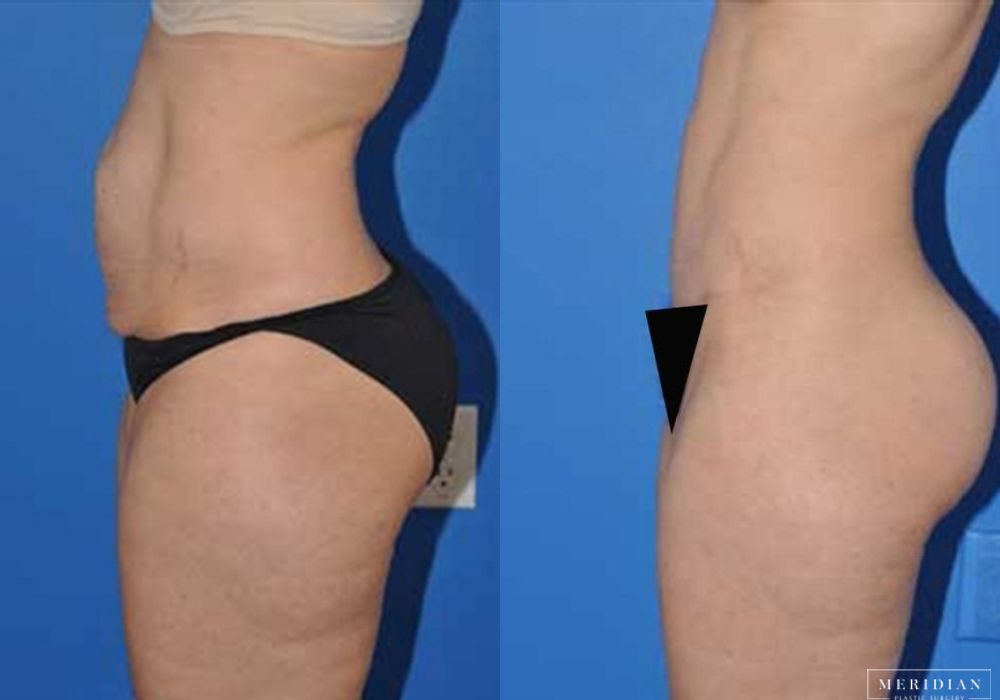 Body Contouring - Thumbnail 2