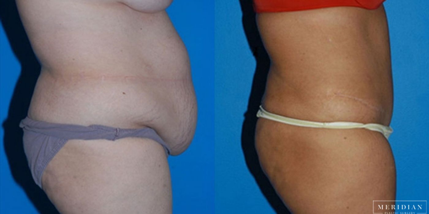 Body Contouring - Thumbnail 2