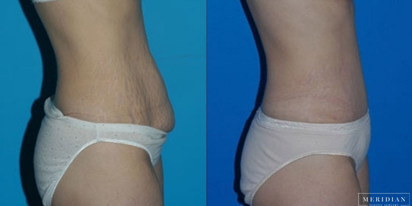 Body Contouring - Thumbnail 2