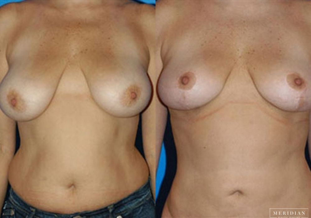 Body Contouring - Case 7980