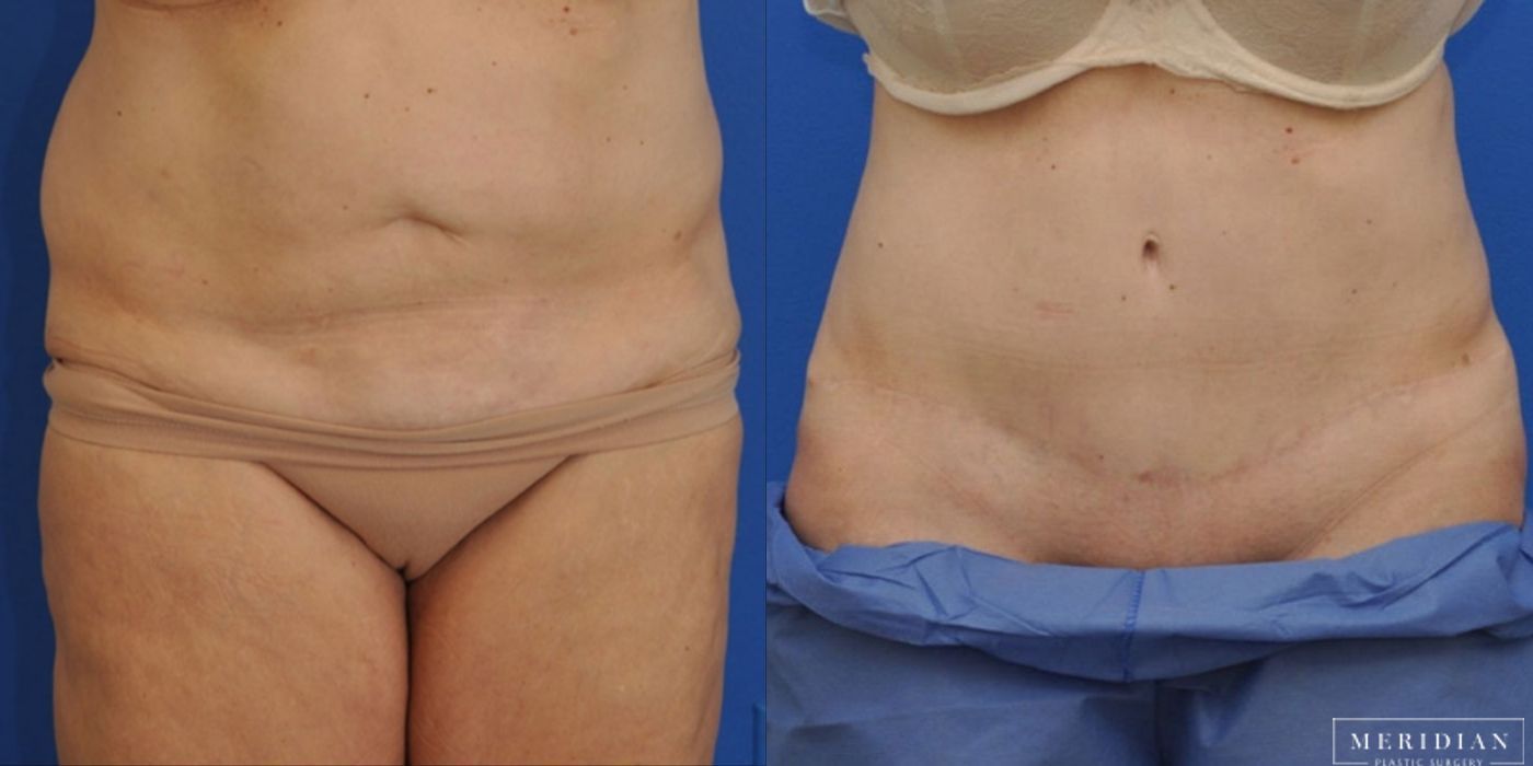 Body Contouring - Case 8453