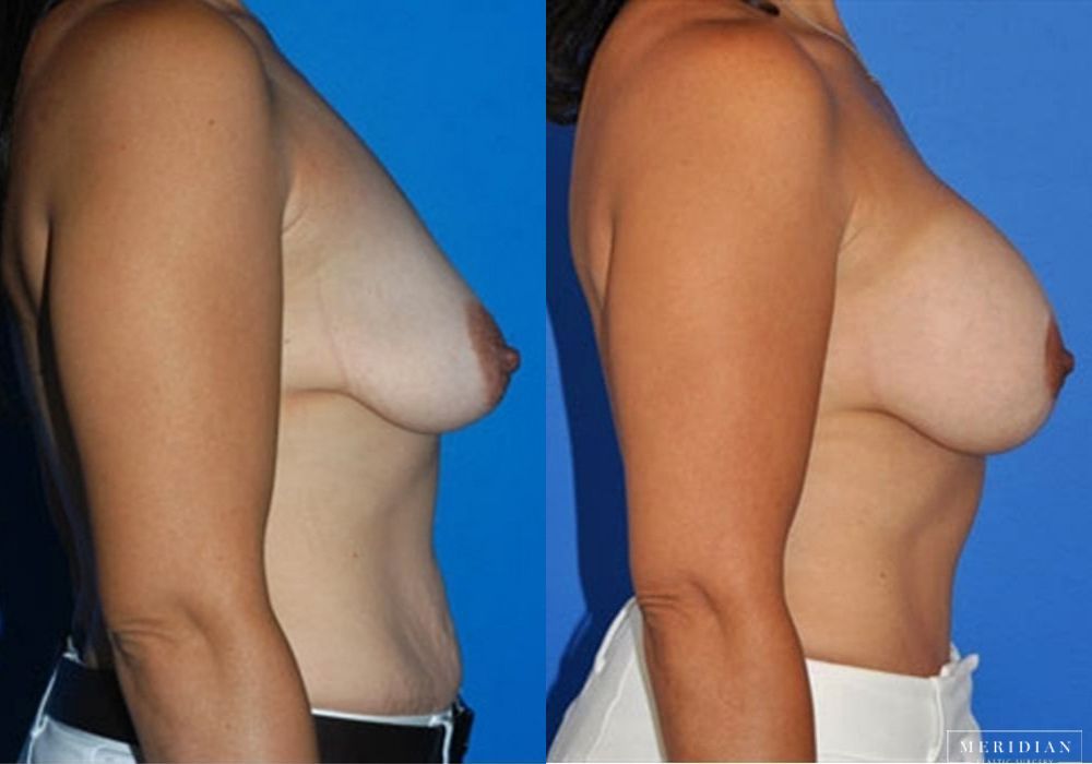 Body Contouring - Thumbnail 2