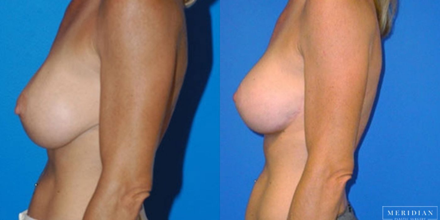 Body Contouring - Thumbnail 2