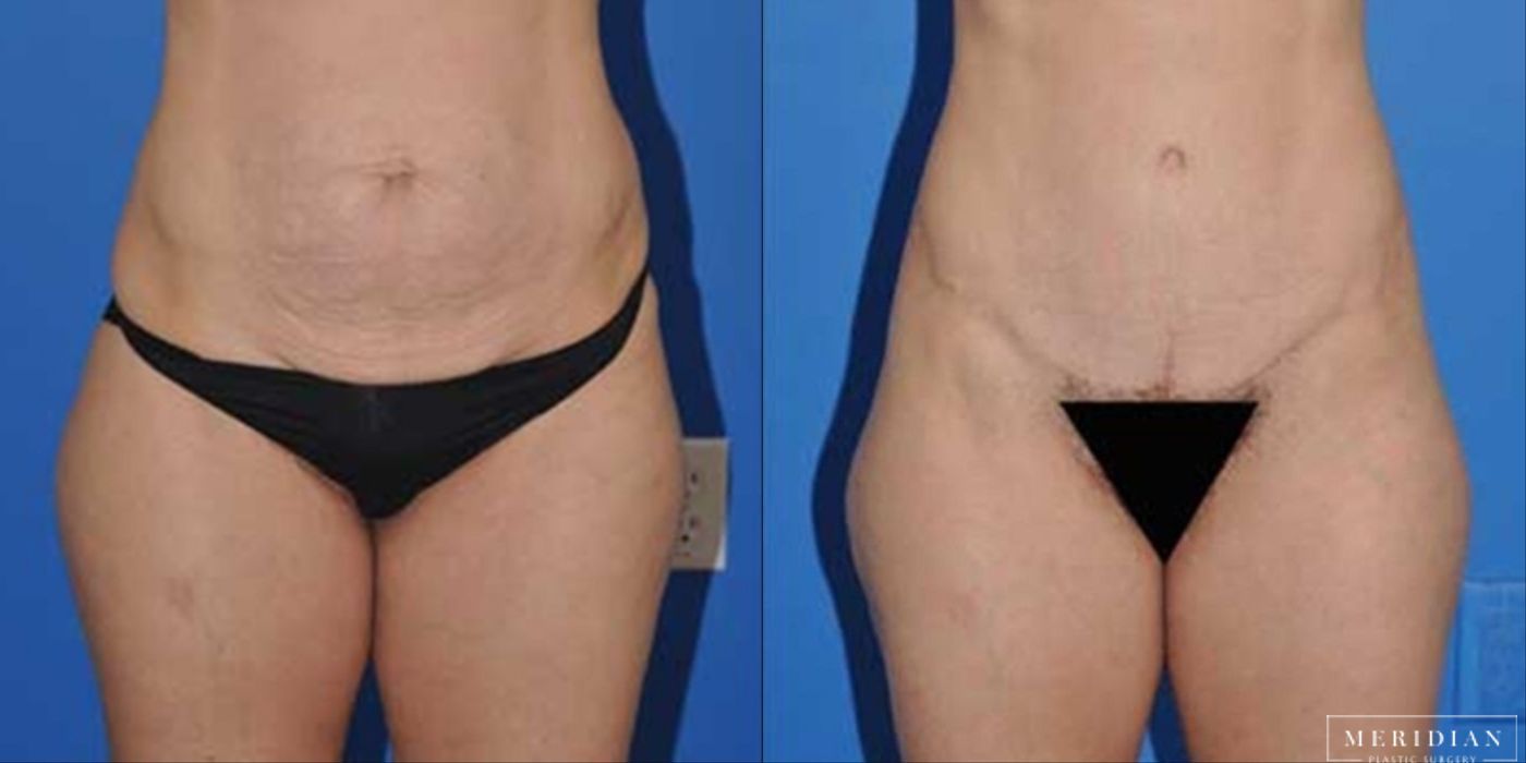 Body Contouring - Case 8446